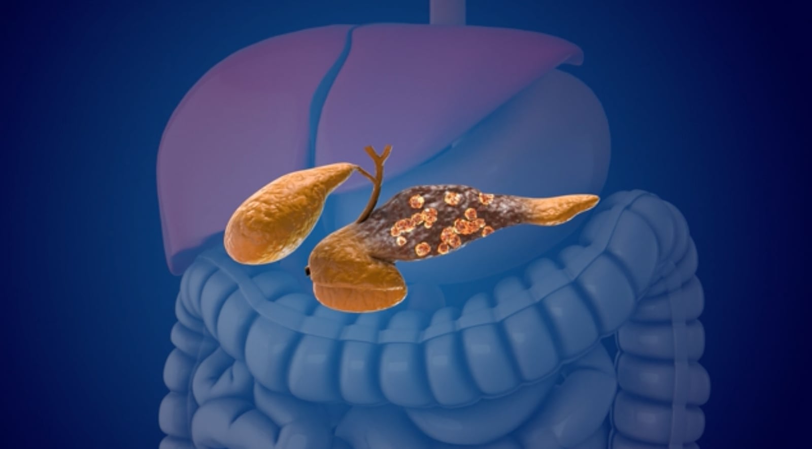Tres años antes del diagnóstico, el cáncer de páncreas ya deja huella
